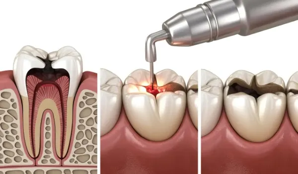 Dental Filling Treatment​